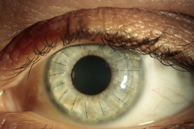 Picture1Photo of an eye after DALK The appearance of the eye after Deep Anterior Lamellar Keratoplasty
