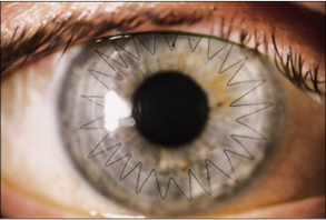 Photo of an eye after DALK The appearance of the eye after Deep Anterior Lamellar Keratoplasty