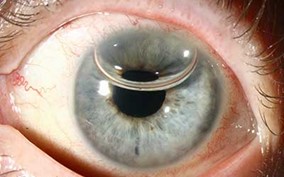 Photo of an eye three days after DMEK surgery The appearance of the eye three days after DMEK surgery