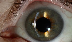 Photo of an eye one month after DMEK surgery The appearance of the eye one month after DMEK surgery